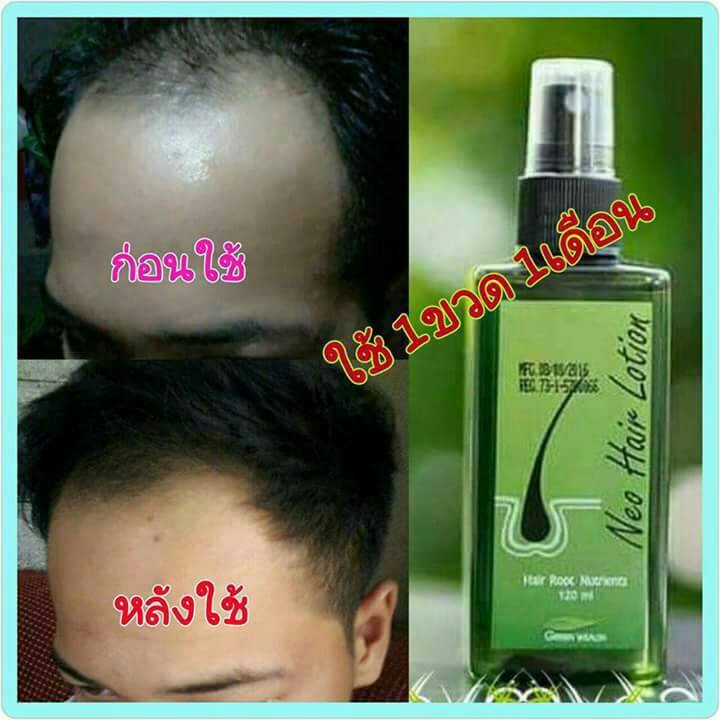 Neo Hair Lotion เซรั่มปลูกผม