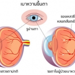 โรคเบาหวานขึ้นตา ?