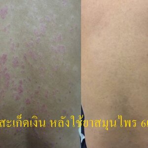 โรคสะเก็ดเงิน ( Psoriasis ) โรคสะเก็ดเงินคืออะไร